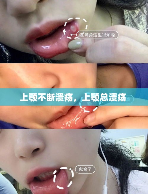上顎不斷潰瘍，上顎總潰瘍 