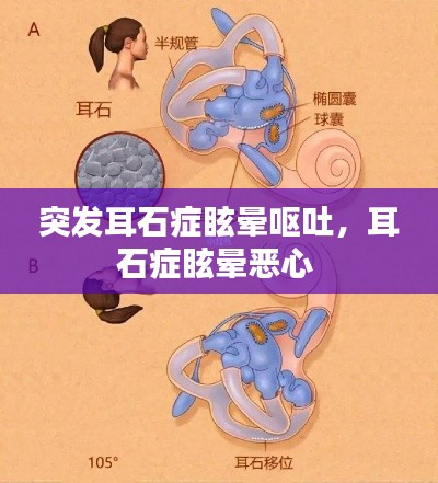 突發(fā)耳石癥眩暈嘔吐，耳石癥眩暈惡心 