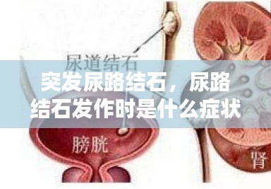 突發(fā)尿路結(jié)石，尿路結(jié)石發(fā)作時(shí)是什么癥狀? 