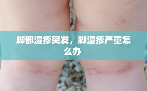 腳部濕疹突發(fā)，腳濕疹嚴(yán)重怎么辦 