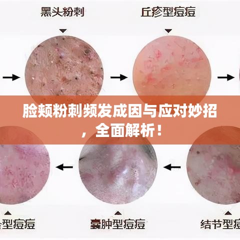 臉頰粉刺頻發(fā)成因與應(yīng)對妙招，全面解析！